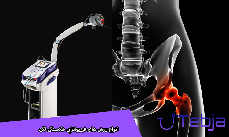 انواع روش های فیزیواتراپی شکستگی لگن
