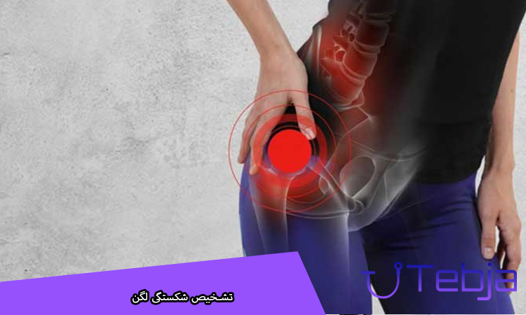 تشخیص شکستگی لگن