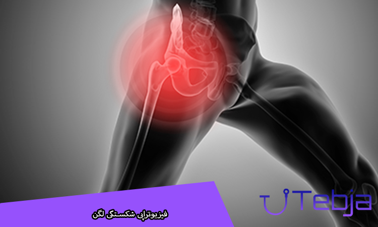فیزیوتراپی شکستگی لگن